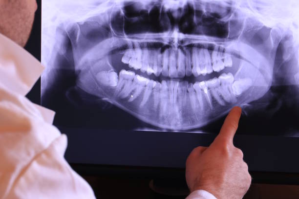 Best Knocked-Out Tooth (Avulsed Tooth) Treatment in Wayne, PA